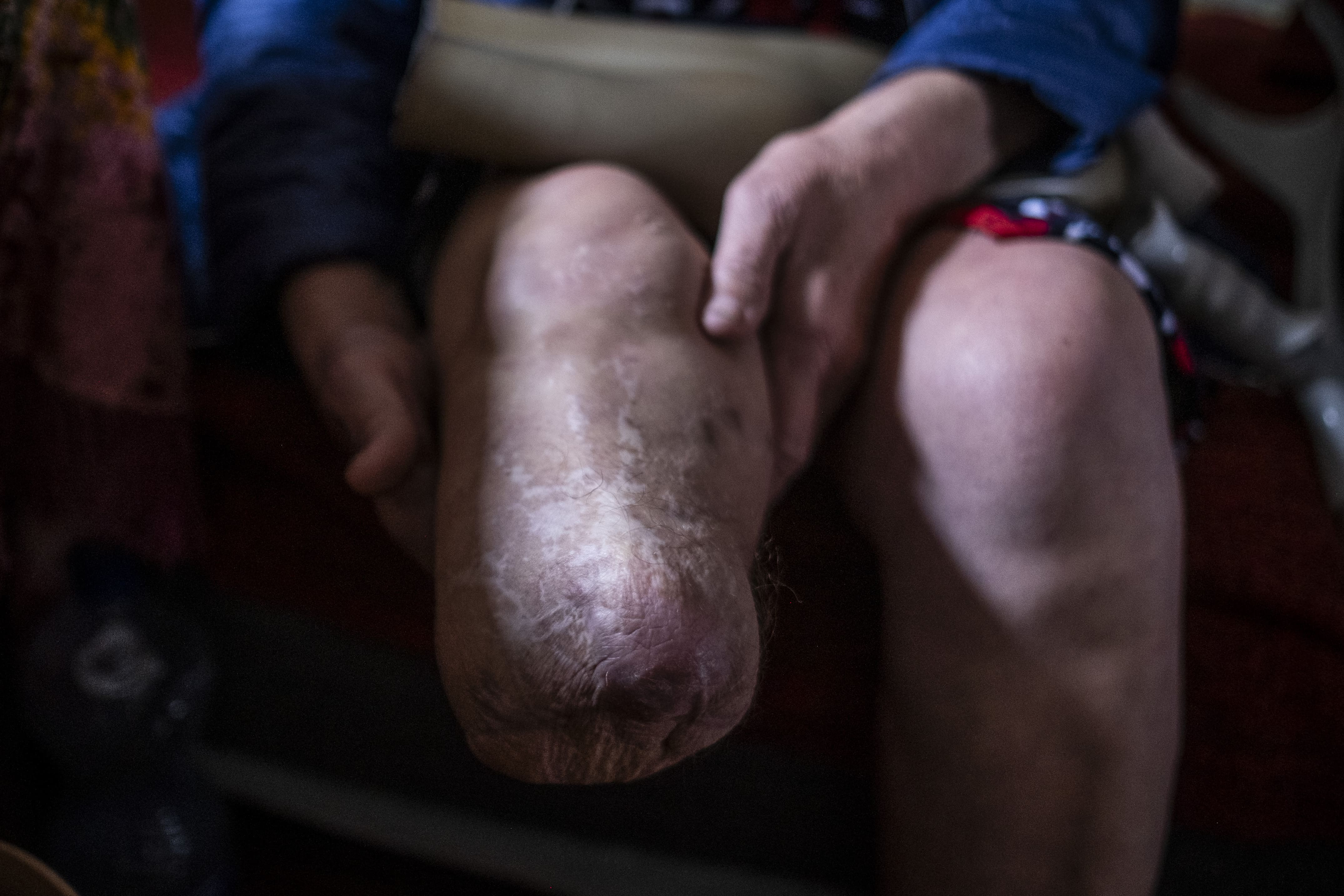Presque deux ans après avoir marché sur une mine PFM-1 (mine pétale),  le 16 mars 2026, Tatiana souffre de la douleur du membre fantôme, la peau de son moignon restant fragile. Tatiana est maintenant suivie par une psychologue d'une ONG internationale qui l'aide à travers une thérapie par miroir.